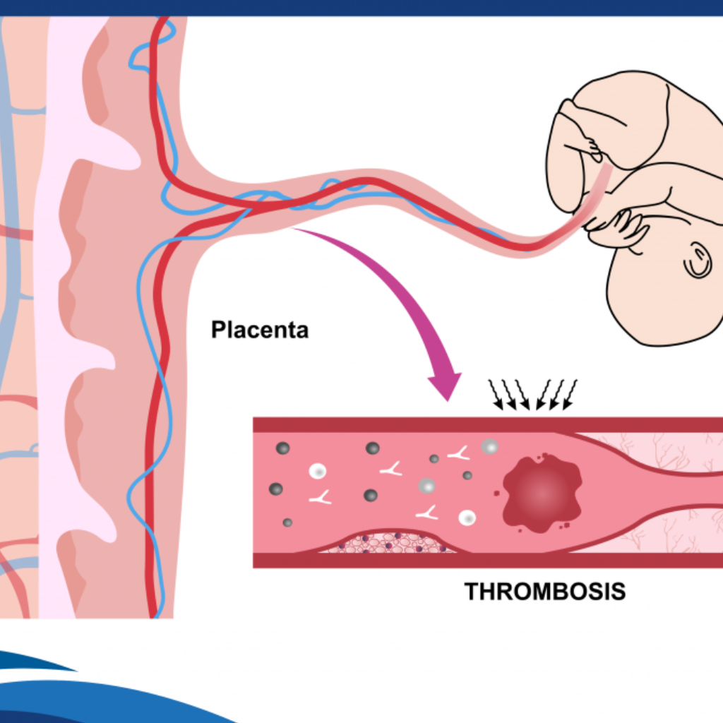 Antifosfolipid sindrom (AFS)